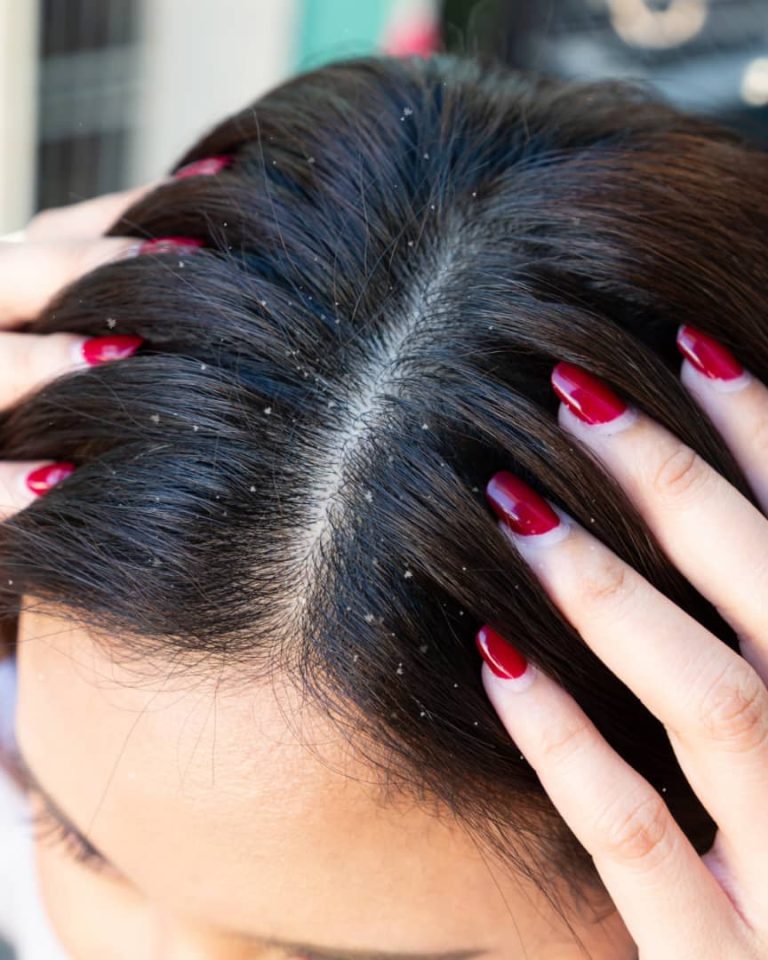 how to treat dandruff at home